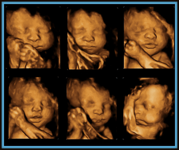 4 Different Types Of Ultrasound For Pregnancy Aiht Education 